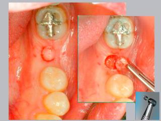 IMPLANTES WEB 55